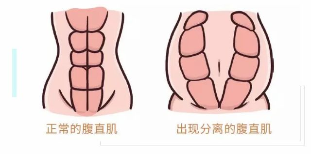 1572419633459276.png 產(chǎn)后腹直肌修復(fù)